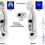 Sex differences affect efficacy of opioid overdose treatment, whole-body PET study reveals